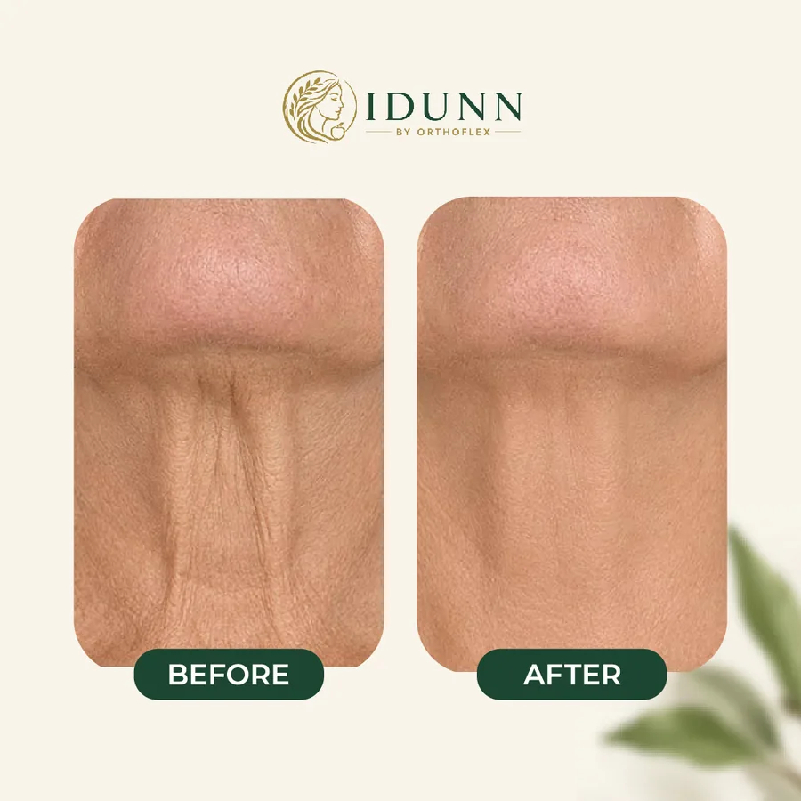 Before and after — Neck lines, at the IDUNN clinic
