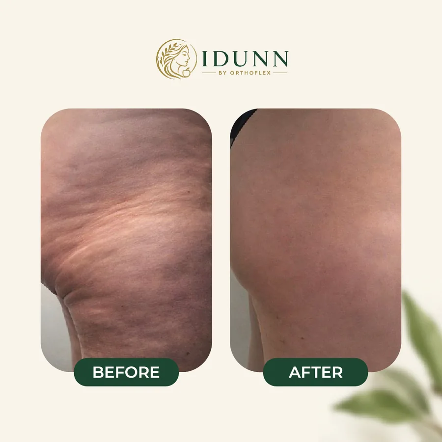 Before and after — Neck skin texture, at the IDUNN clinic