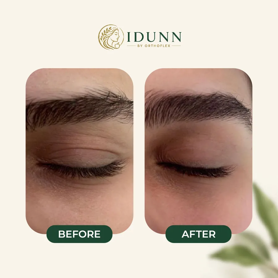 Before and after — Brow, at the IDUNN clinic