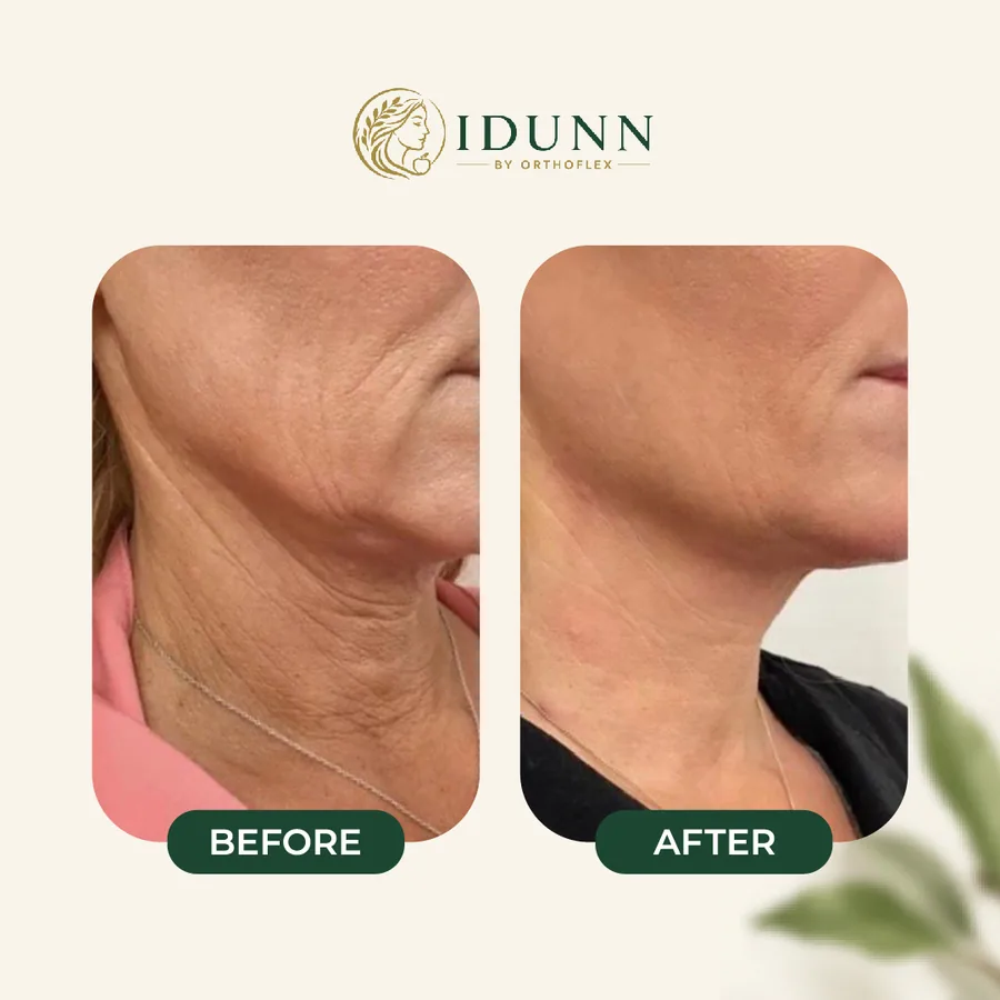 Before and after — Jawline and neck, at the IDUNN clinic