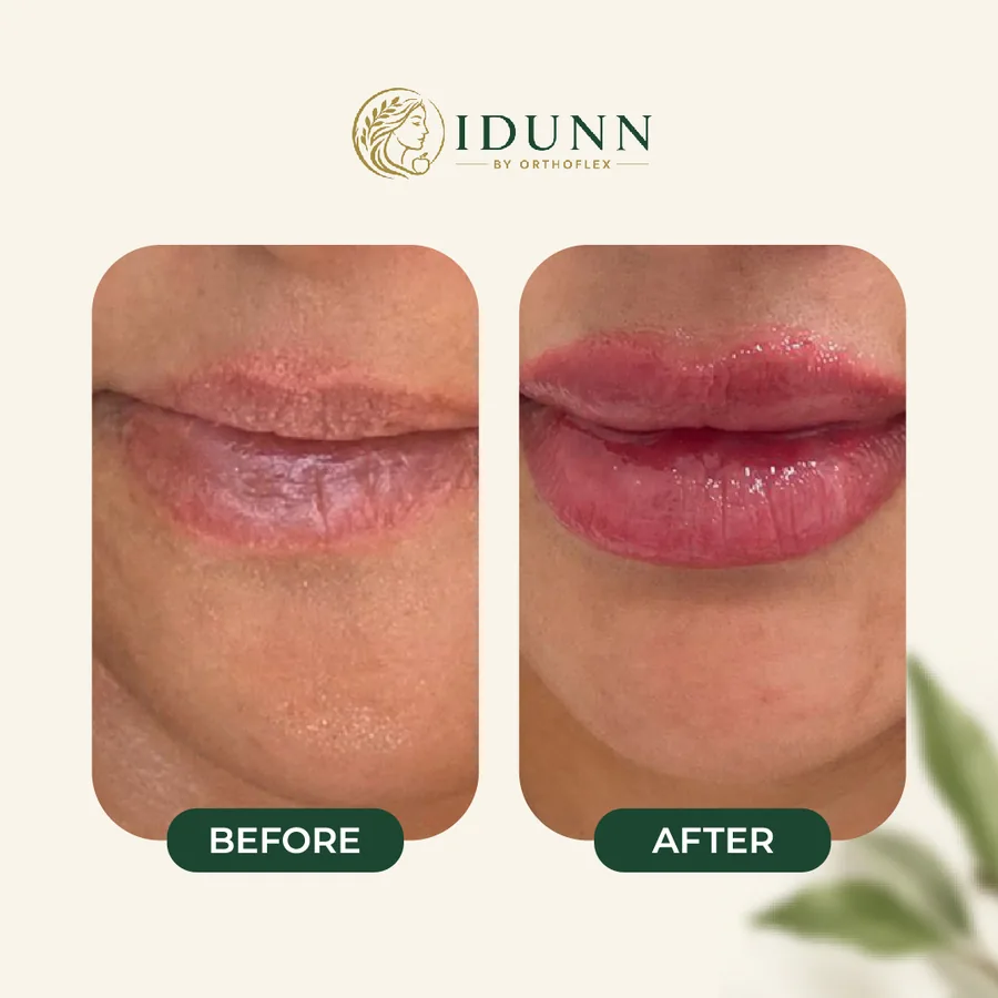 Before and after — Lips, at the IDUNN clinic