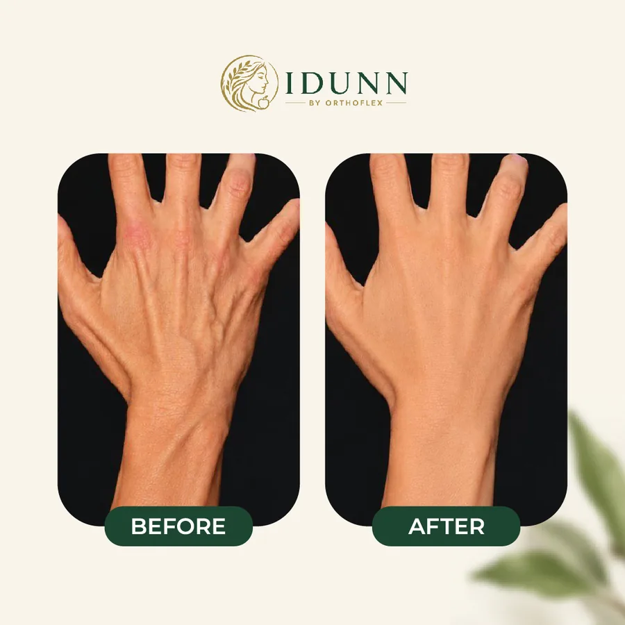 Before and after — Back of the hand, at the IDUNN clinic