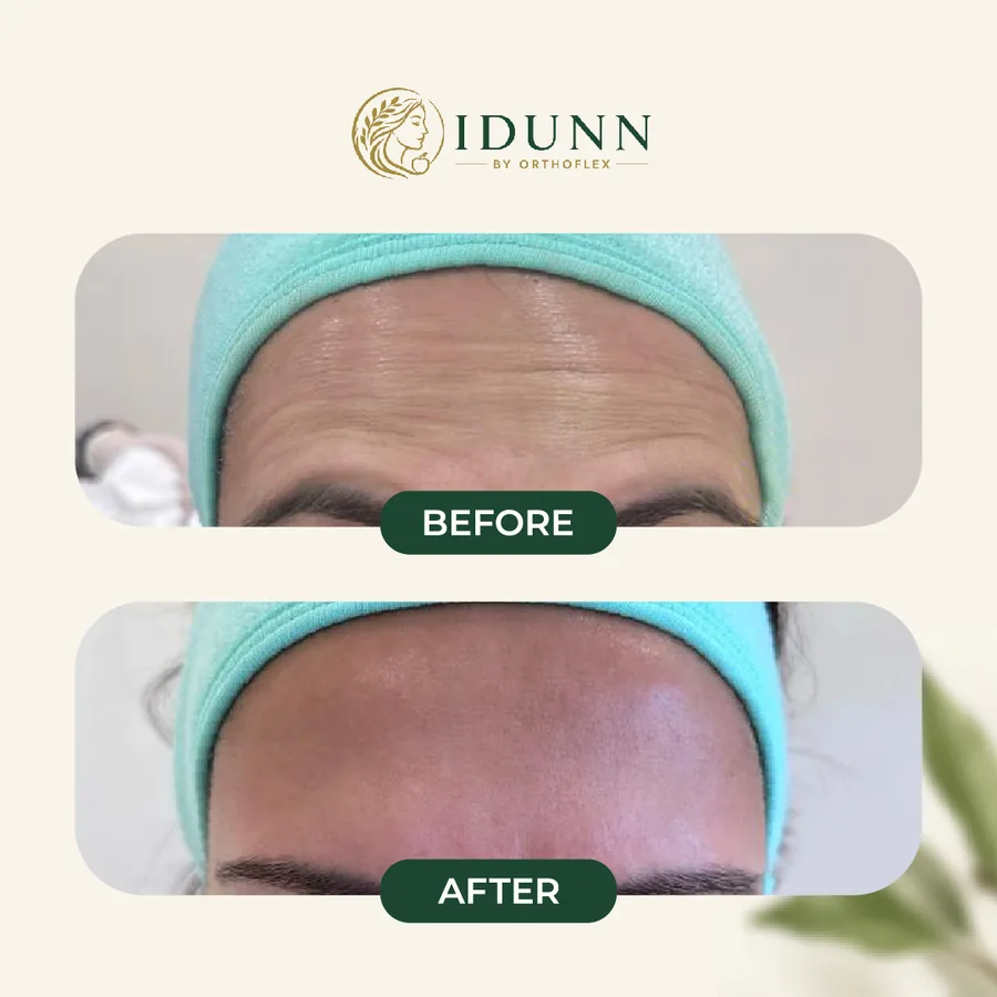 Before and after — Forehead lines, at the IDUNN clinic